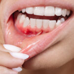 Dental Abscess or Tooth Infection Signs