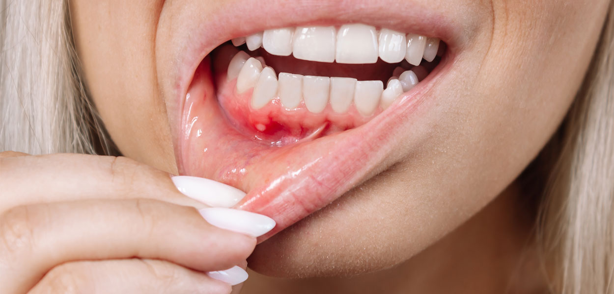 Dental Abscess or Tooth Infection Signs