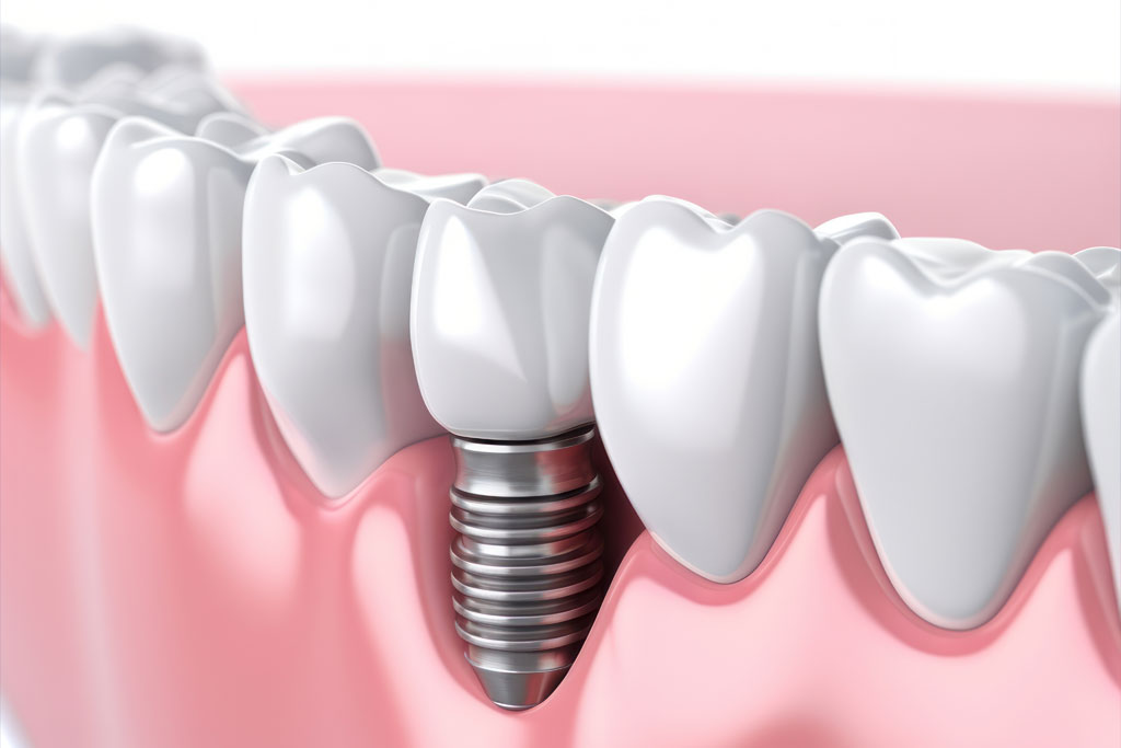 Dental implants