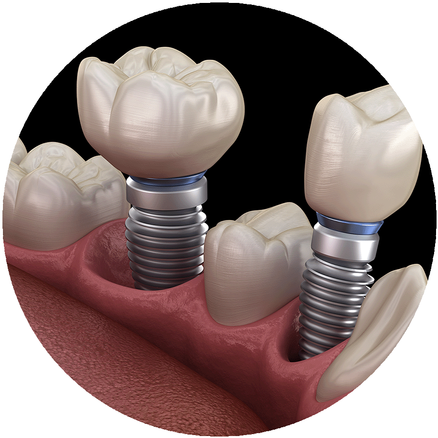 Implant Dentistry