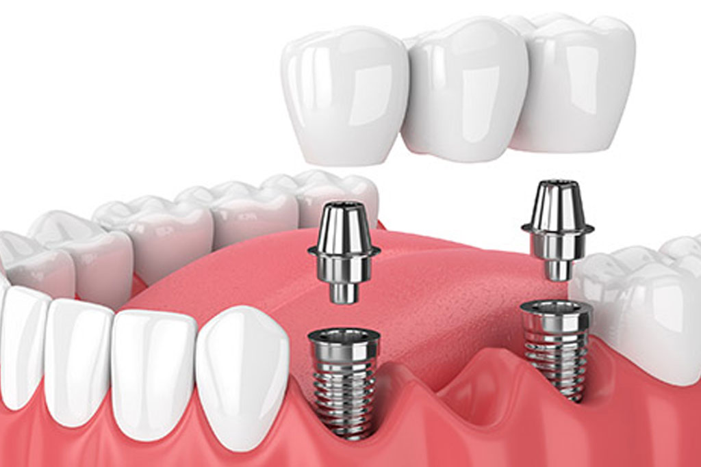 Implant Supported Bridges