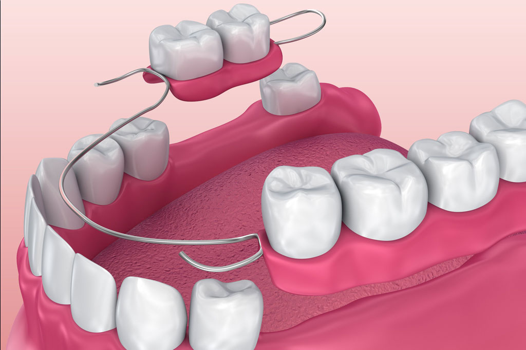 Removable Partial Dentures