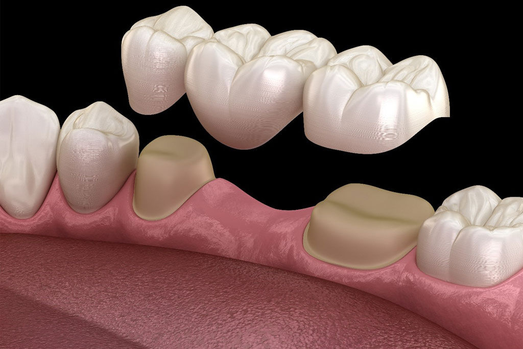 Tooth Supported Bridges