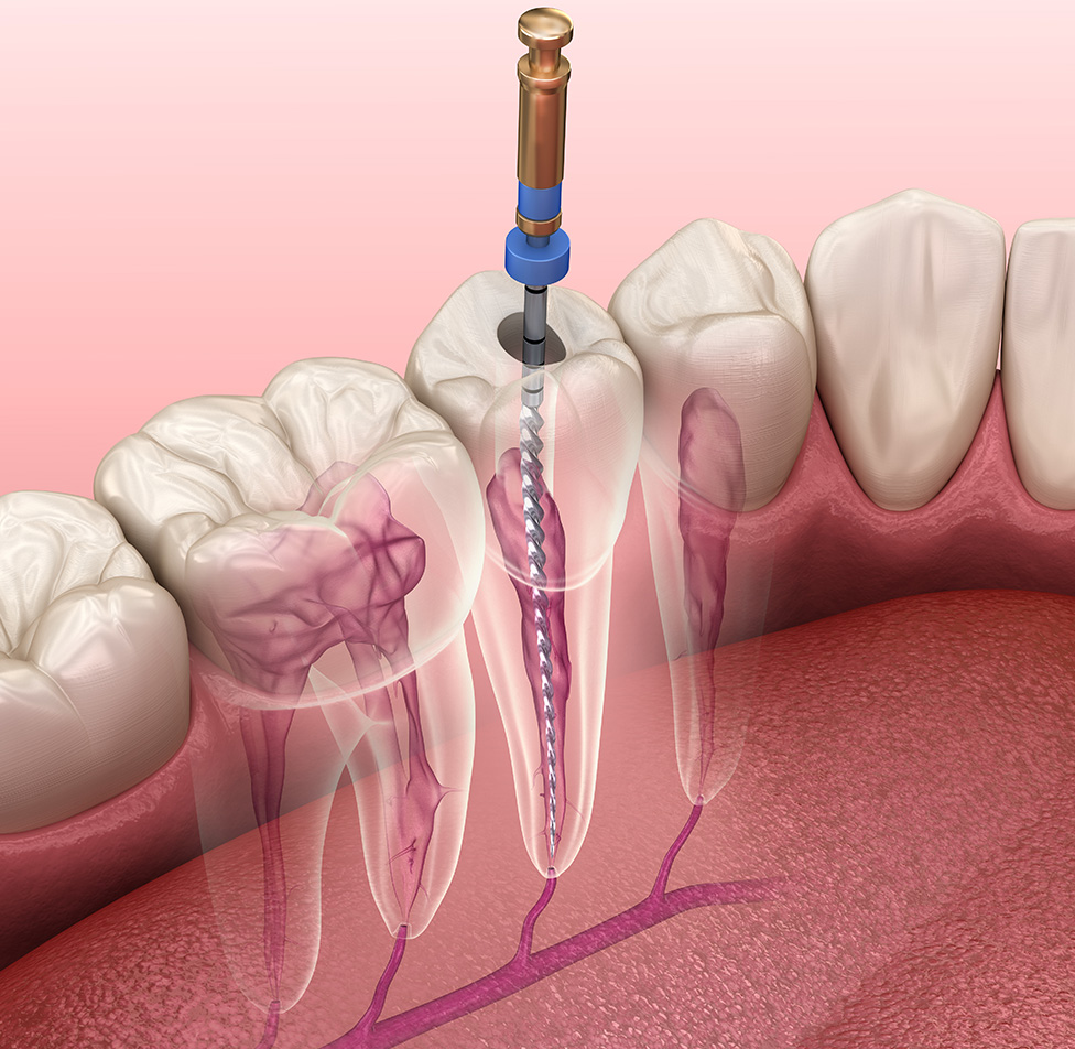 root canal treatment