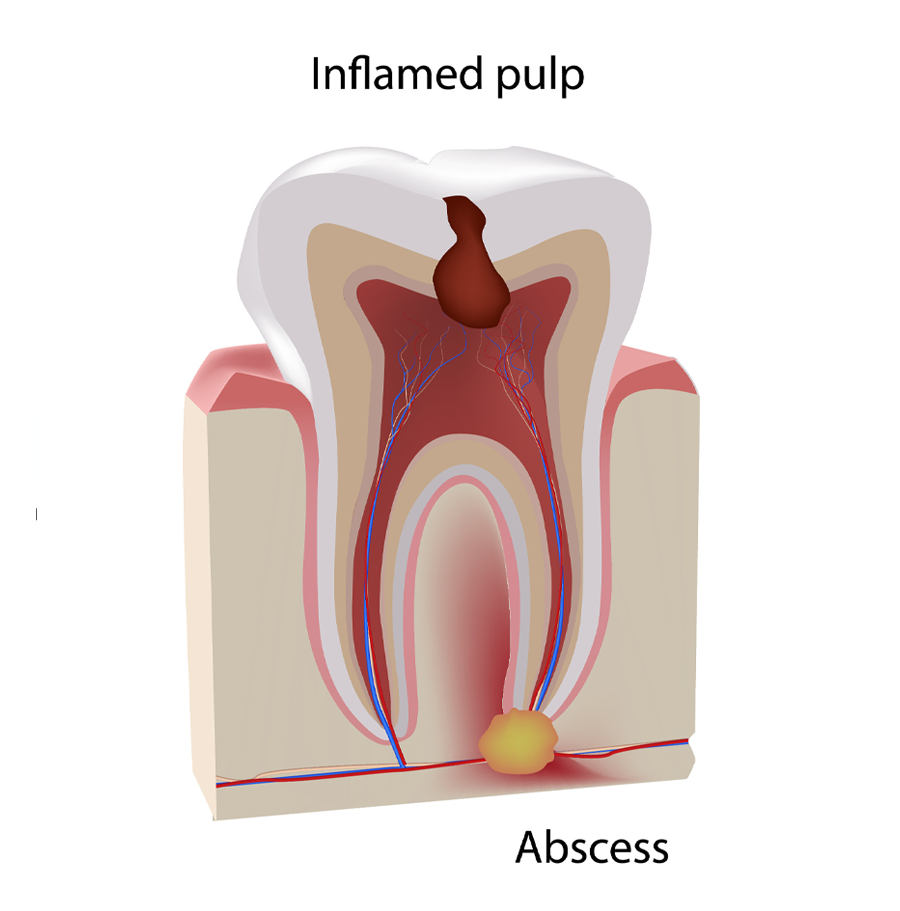 Dental Abscesses