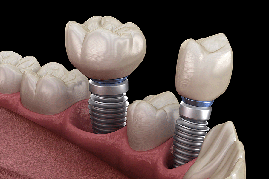 Dental Implants