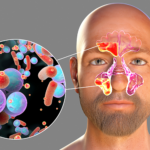 Sinusitis Vs Dental Abscess