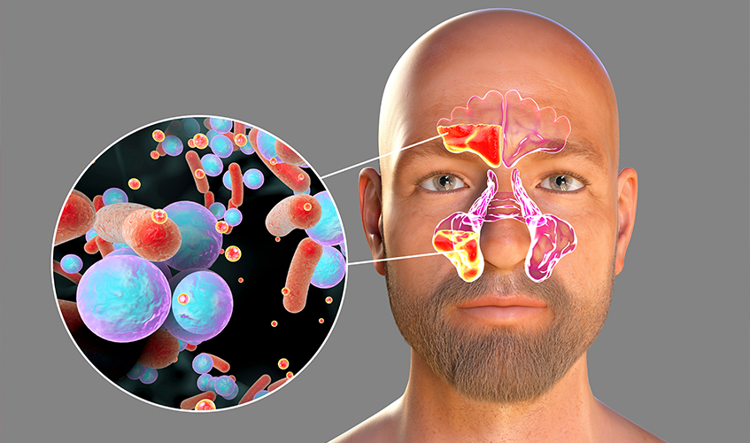 Sinusitis Vs Dental Abscess