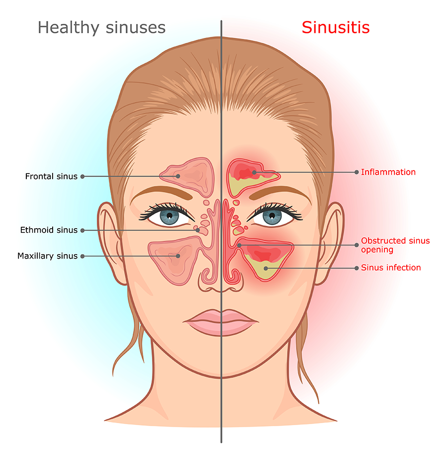 Sinusitis