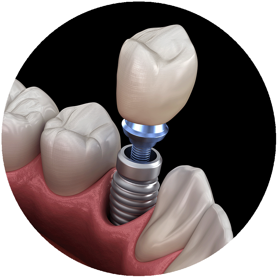 Dental Implant Crown