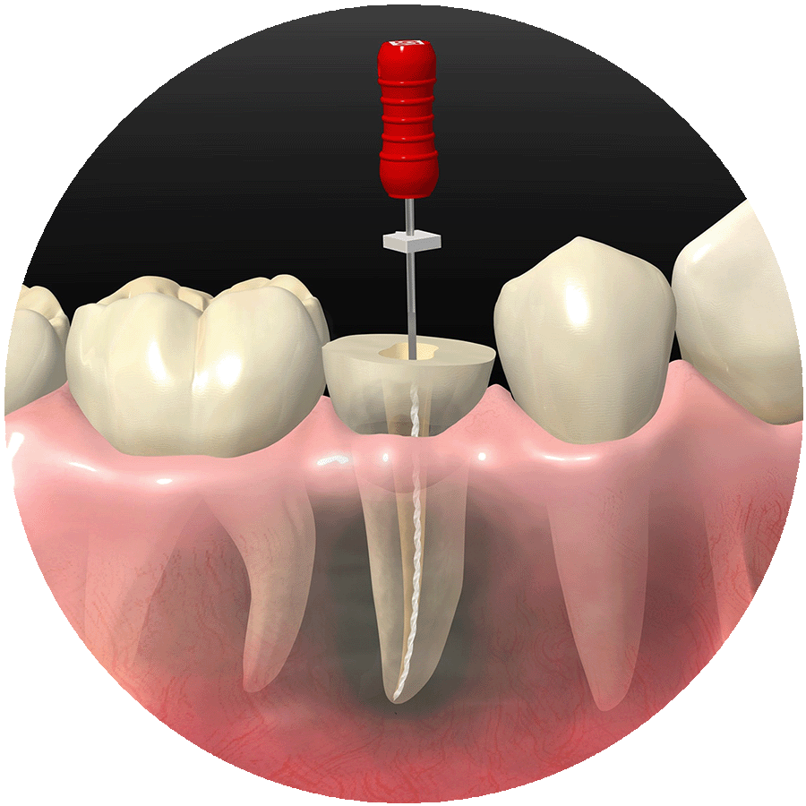 Root Canal