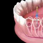 root canal cost MA