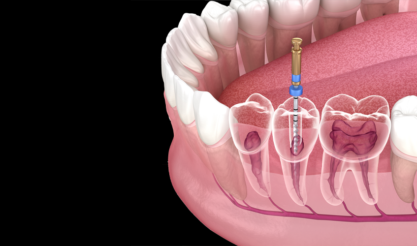 root canal cost MA