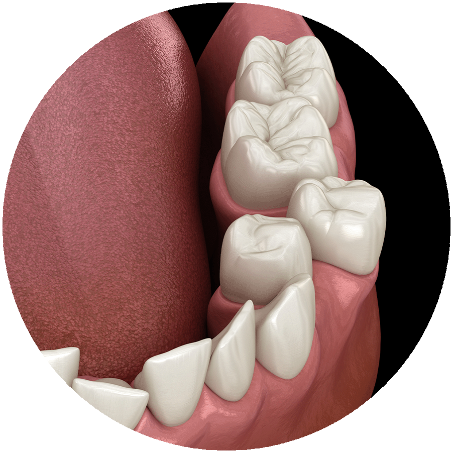 Dental Crowding