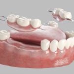 Denture Stages Fitchburg