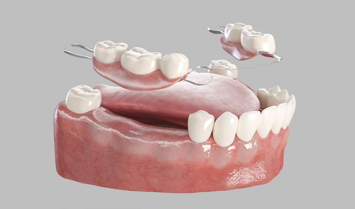 Denture Stages Fitchburg