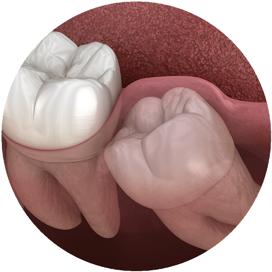 Remove Impacted Tooth